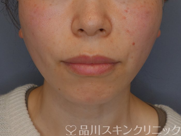 症例NO.72439のAFTER写真