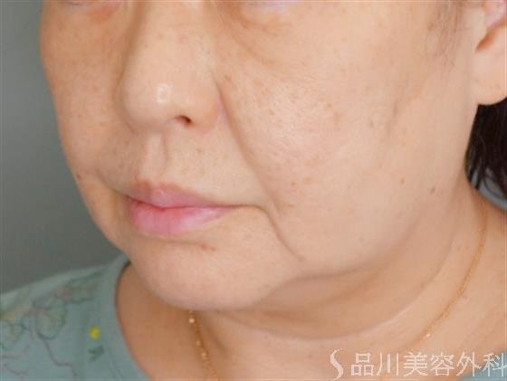 症例NO.53041のBEFORE写真