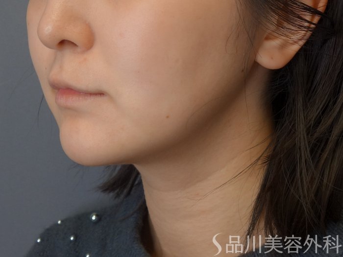 症例NO.72913のBEFORE写真