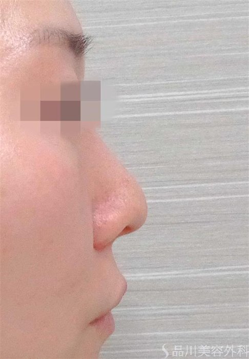症例NO.60439のBEFORE写真