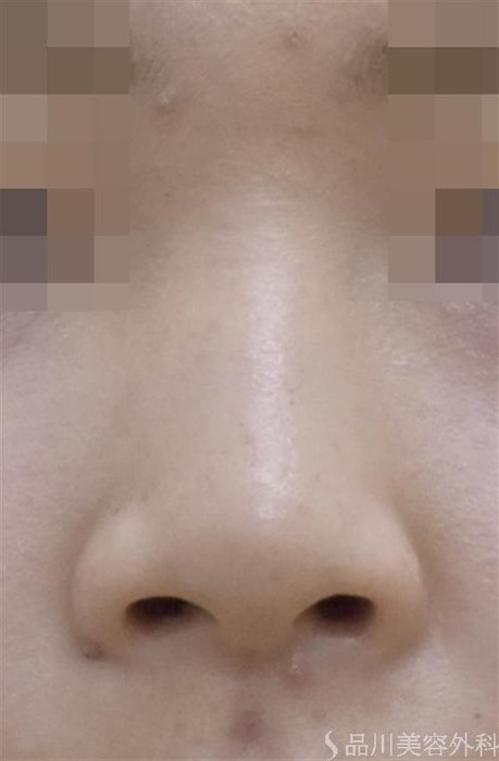 症例NO.51176のBEFORE写真
