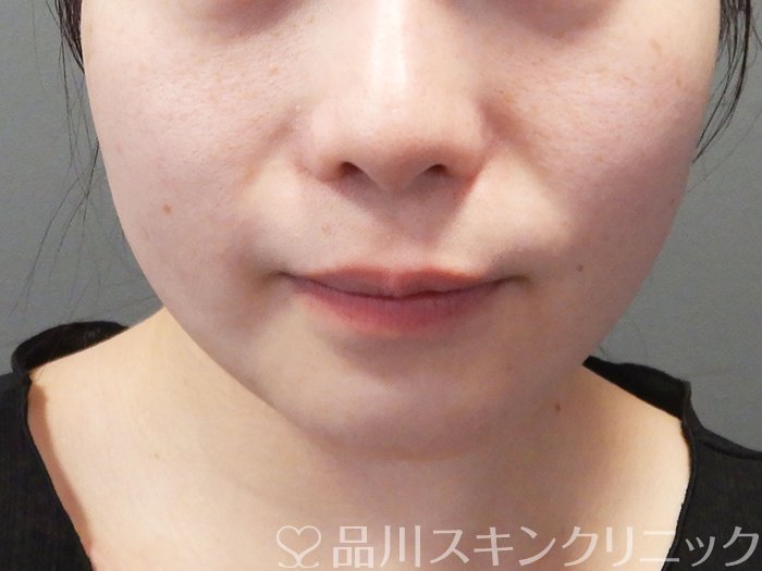 症例NO.72522のBEFORE写真