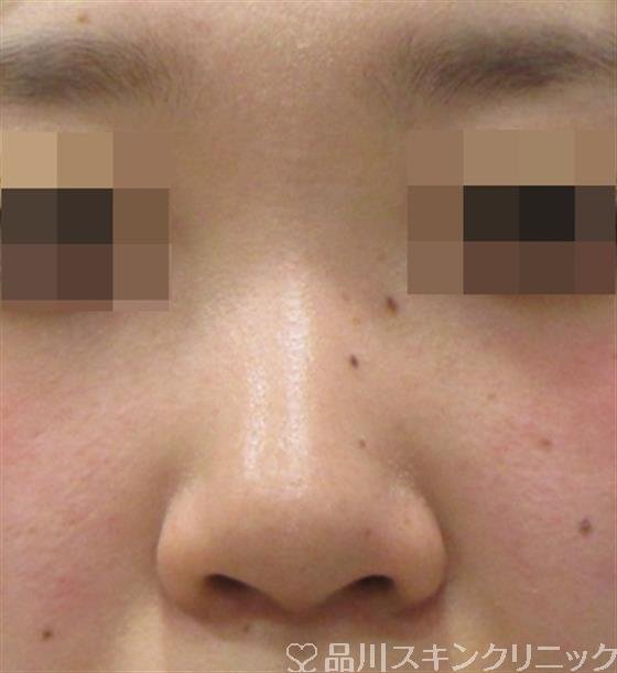 症例NO.27138のBEFORE写真