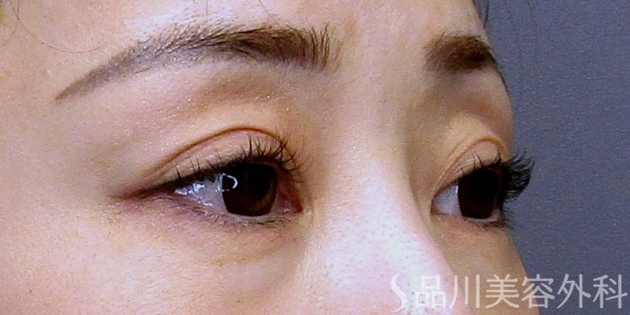 症例NO.75145のBEFORE写真