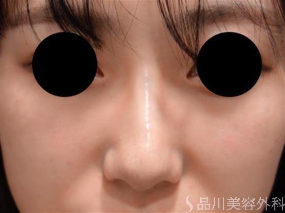 症例NO.50301のAFTER写真