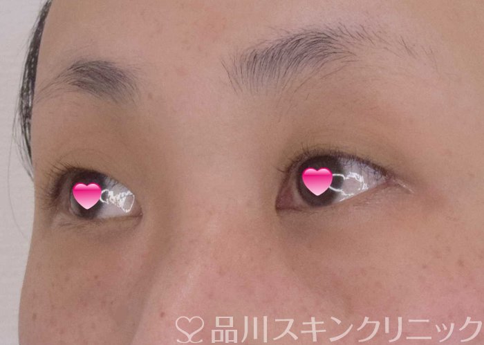 症例NO.64348のBEFORE写真