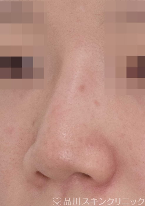 症例NO.67652のBEFORE写真