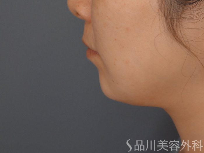 症例NO.65314のBEFORE写真