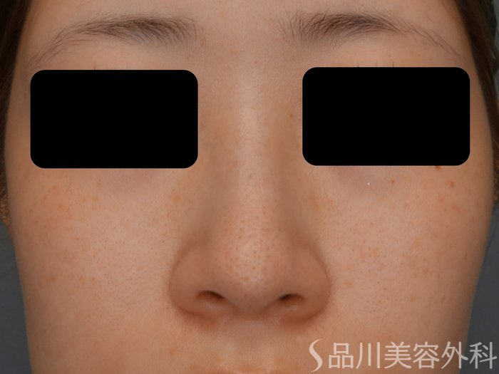 症例NO.74933のBEFORE写真