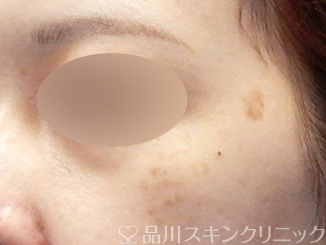 症例NO.68612のBEFORE写真