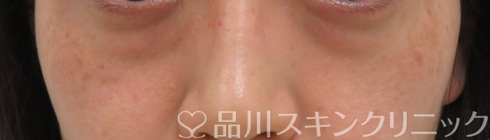 症例NO.66520のBEFORE写真