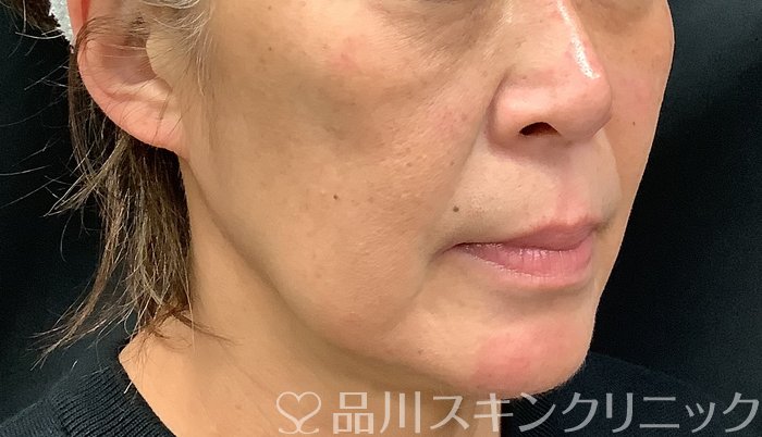 症例NO.67887のBEFORE写真