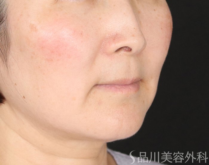 症例NO.72077のBEFORE写真