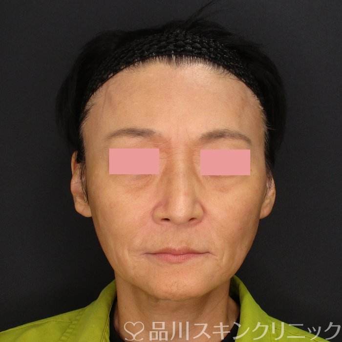 症例NO.71884のAFTER写真