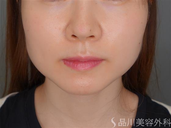 症例NO.52937のBEFORE写真