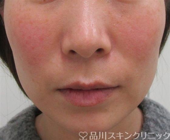症例NO.33339のBEFORE写真