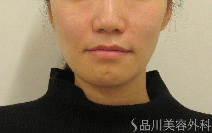 症例NO.72989のAFTER写真