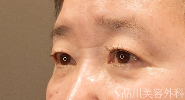 症例NO.75353のBEFORE写真
