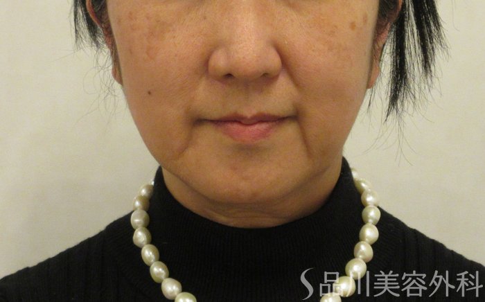 症例NO.72374のBEFORE写真