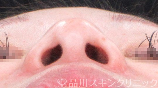症例NO.69666のBEFORE写真