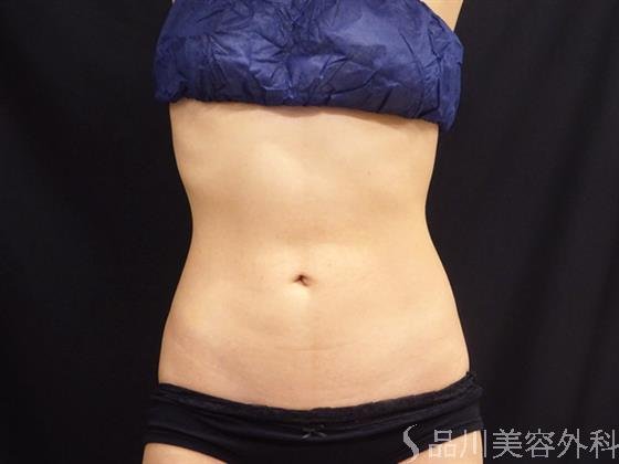 症例NO.51841のAFTER写真