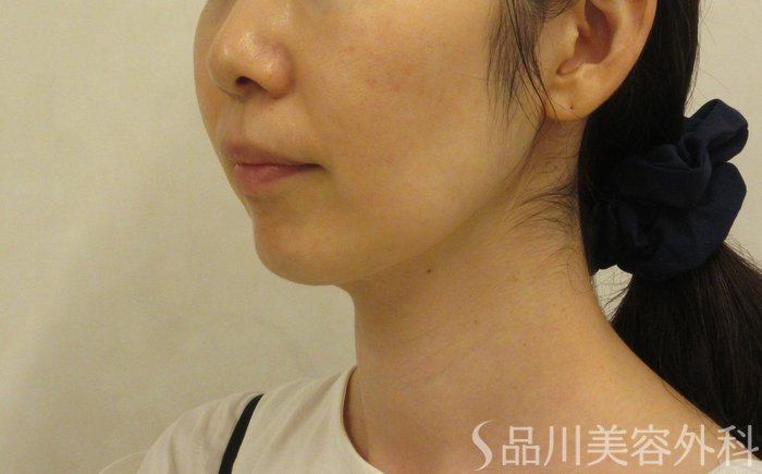 症例NO.71957のBEFORE写真