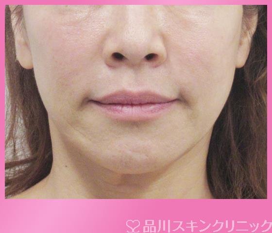 症例NO.28030のAFTER写真
