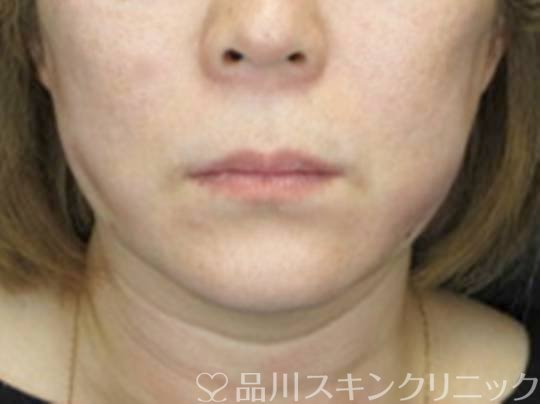 症例NO.73947のAFTER写真