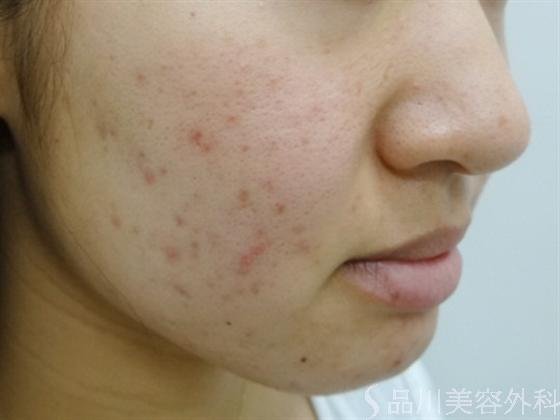 症例NO.17608のBEFORE写真