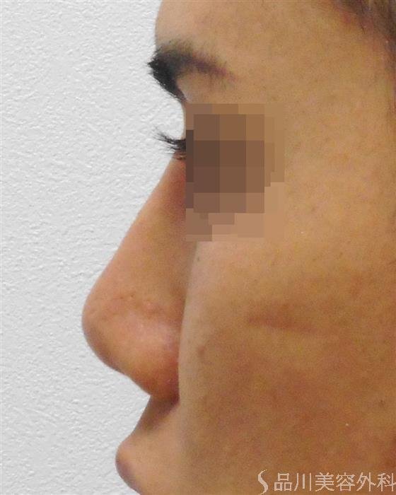 症例NO.37367のAFTER写真