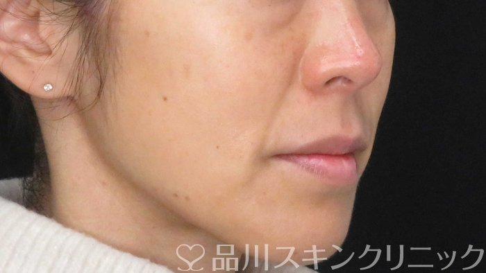 症例NO.71223のBEFORE写真