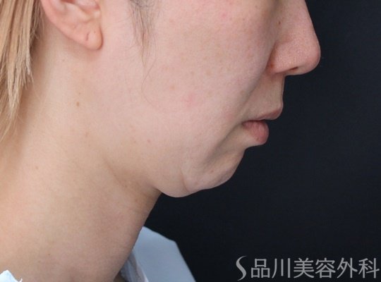 症例NO.70800のBEFORE写真