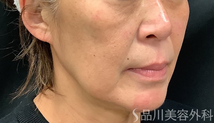 症例NO.67887のBEFORE写真