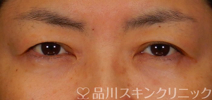 症例NO.67467のBEFORE写真