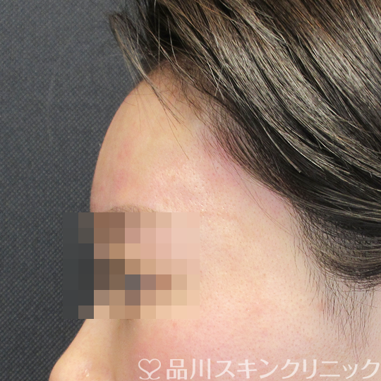 症例NO.69995のAFTER写真