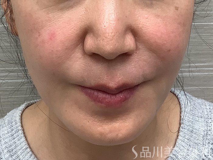 症例NO.62261のBEFORE写真