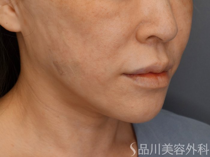 症例NO.71520のAFTER写真
