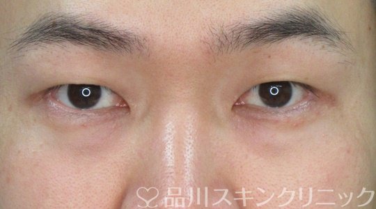 症例NO.71790のBEFORE写真