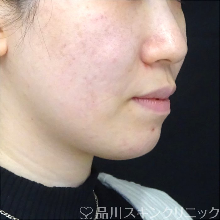 症例NO.69855のAFTER写真
