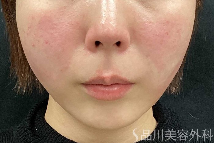 症例NO.62966のAFTER写真