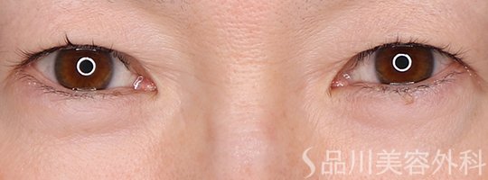 症例NO.72136のBEFORE写真