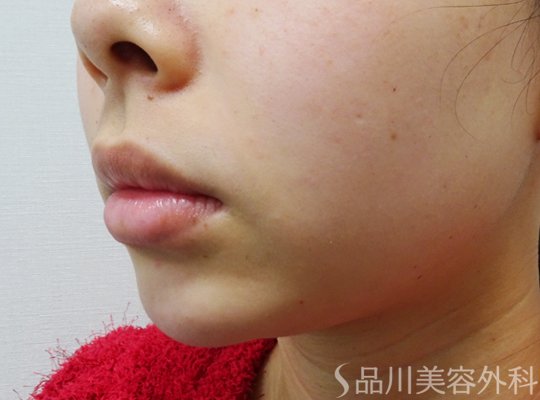 症例NO.73361のAFTER写真