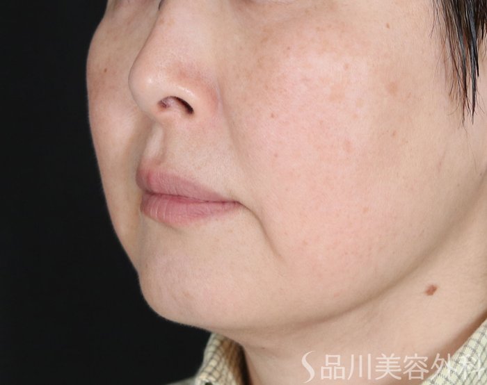 症例NO.72645のBEFORE写真