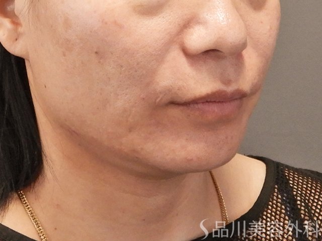症例NO.75133のAFTER写真