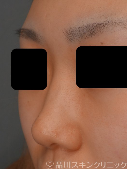 症例NO.75238のBEFORE写真