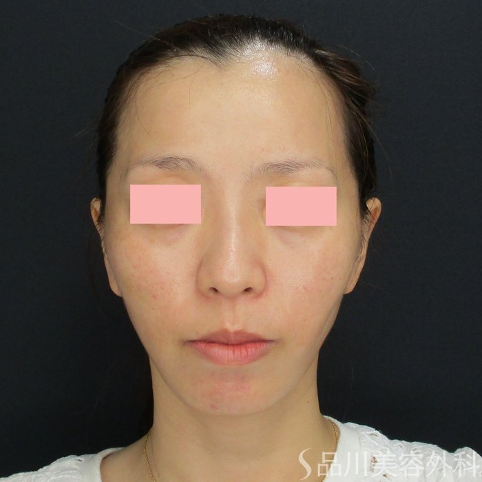 症例NO.71878のAFTER写真