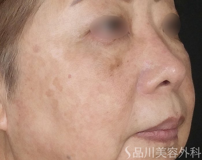 症例NO.69454のBEFORE写真
