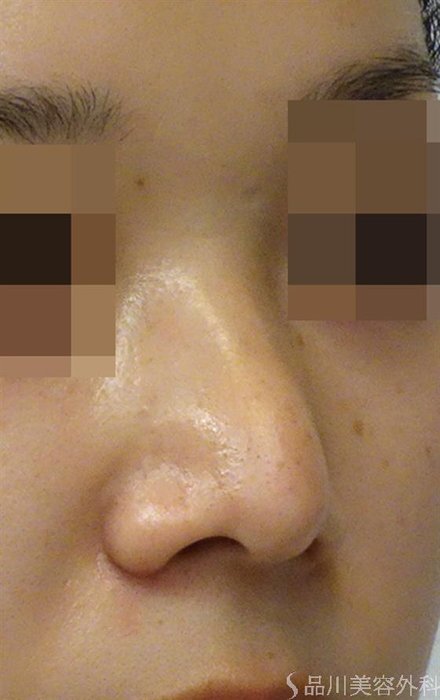 症例NO.40180のAFTER写真