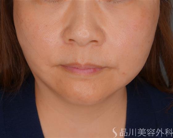 症例NO.53519のAFTER写真