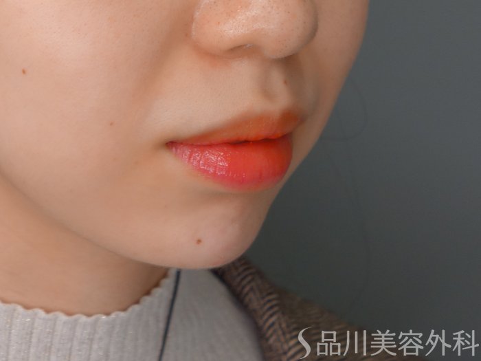 症例NO.69710のAFTER写真
